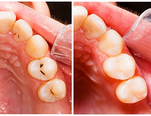 Before and after tooth-colored fillings in Plano, TX