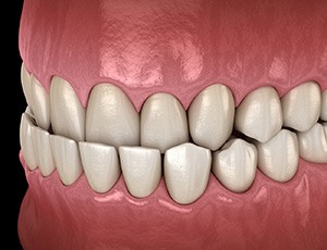 Illustration of an underbite with black background