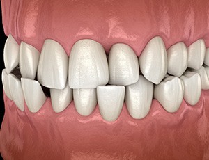 Illustration of a crossbite with black background