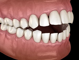 Illustration of an open bite with black background