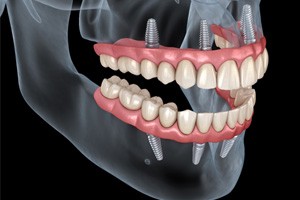 Model All-on-4 dentures