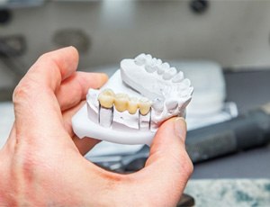 Dental bridge in Plano on clay model