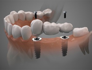 Digital illustration of implant bridge in Plano