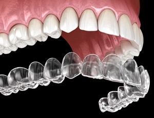 clear aligner illustration