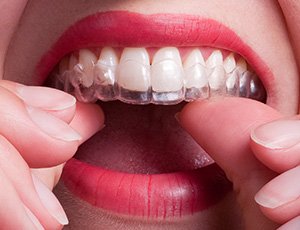 Woman placing Invisalign tray