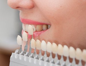 Woman's smile compared with porcelain veneer shade chart