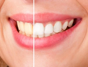 Closeup of smile half before and half after teeth whitening