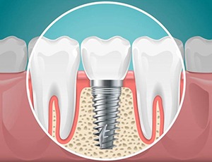 dental implant in the jawbone