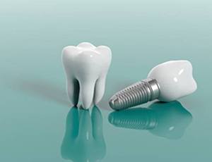 dental implant crown next to a natural tooth