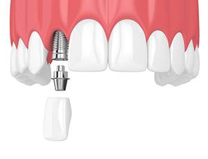 dental implant, abutment, and crown being placed in the upper jaw