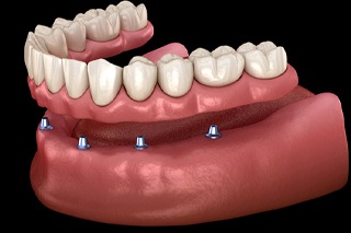 Digital model of denture stabilization in Plano.