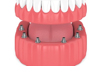 Model of an implant-retained denture.