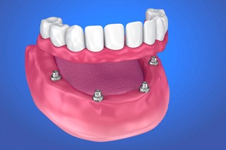 implant-retained denture