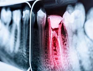 X-ray diagram of a toothache in Plano