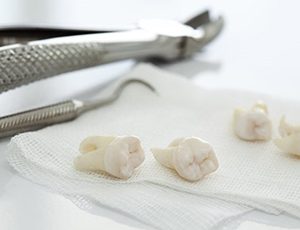several extracted teeth laying on gauze pads 