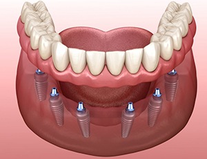 full denture supported by six dental implants 