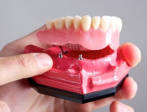 model of an implant denture in a person’s hand 