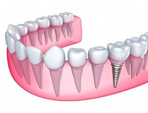 a 3 D illustration of a single dental implant