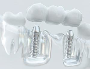 a 3 D illustration of an implant bridge