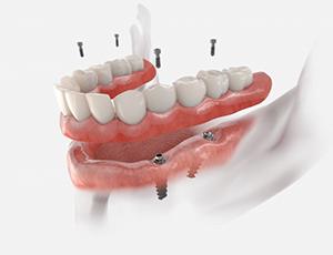 a 3 D illustration of implant dentures