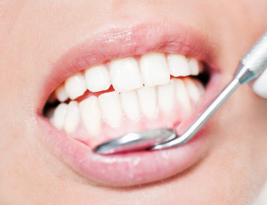 Closeup of smile with healthy teeth and gums after periodontal therapy