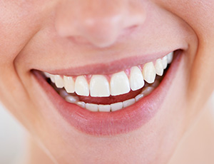 Closeup of healthy attractive smile after fluoride treatment