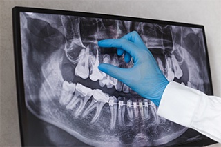 A dentist looking at an x-ray of a smile in need of root canal therapy