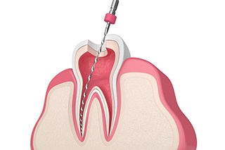 Image of a root canal procedure