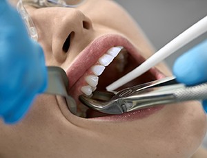 tooth extraction option when considering cost of root canal in Plano  