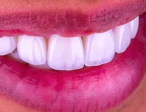 Veneers in Plano