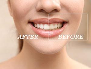 Closeup of patient's smile before and after teeth whitening treatment