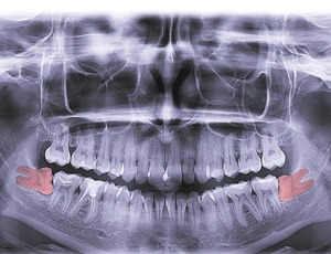 : X-ray showing impacted wisdom teeth in Plano, TX