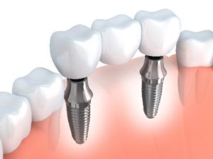 Implant-supported bridge in lower jaw