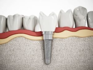 Dental implant in lower jaw