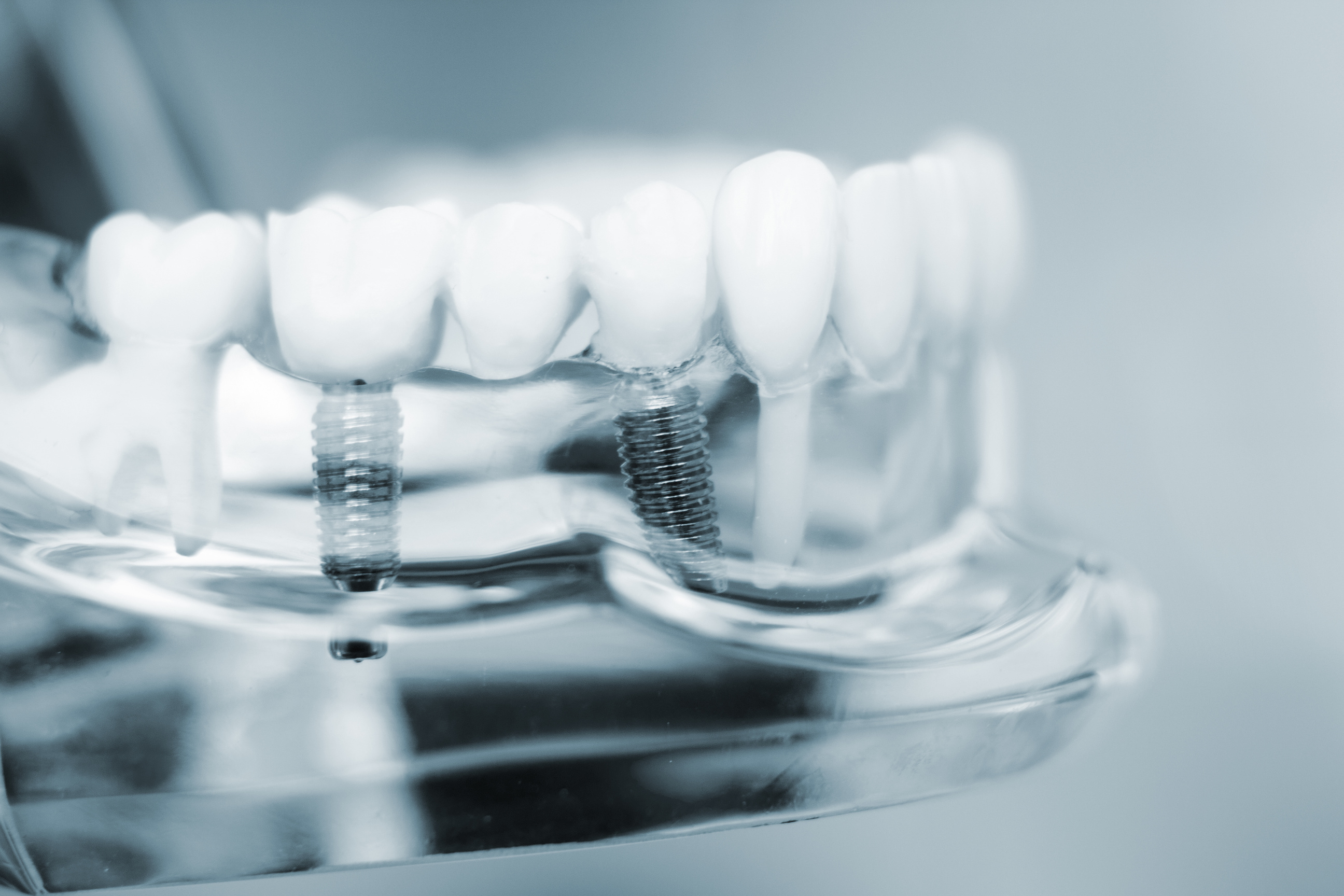 close-up of dental implant