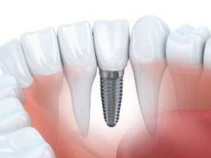 Image of an implant in the bottom jaw