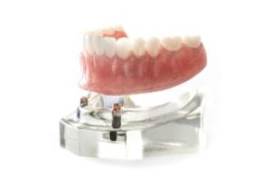 Implant-retained lower arch
