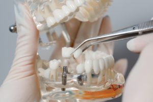 Model showing dental implant success factors.