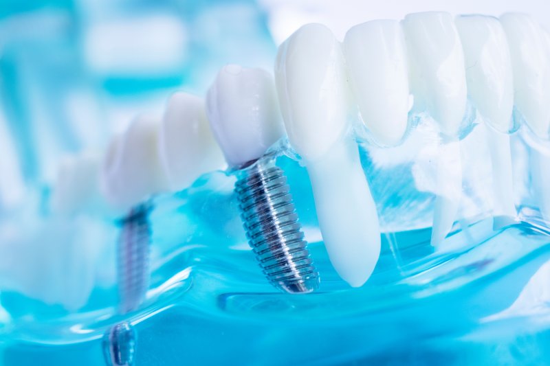 A closeup of dental implants from Plano
