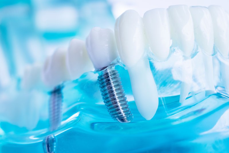 A closeup of dental implants from Plano