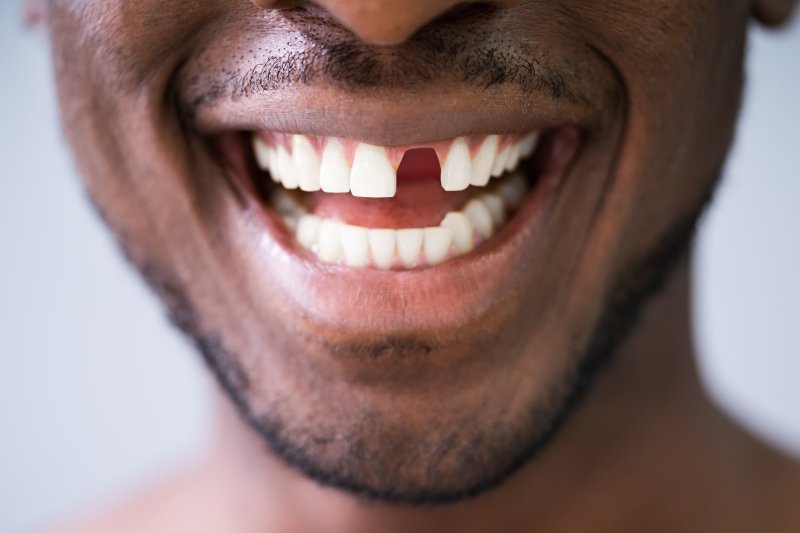 smiling man with a missing front tooth