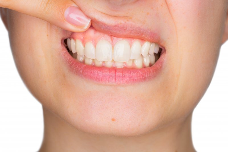 Woman pointing to her gums