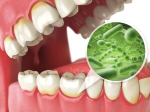 Model of mouth with bacterial infection